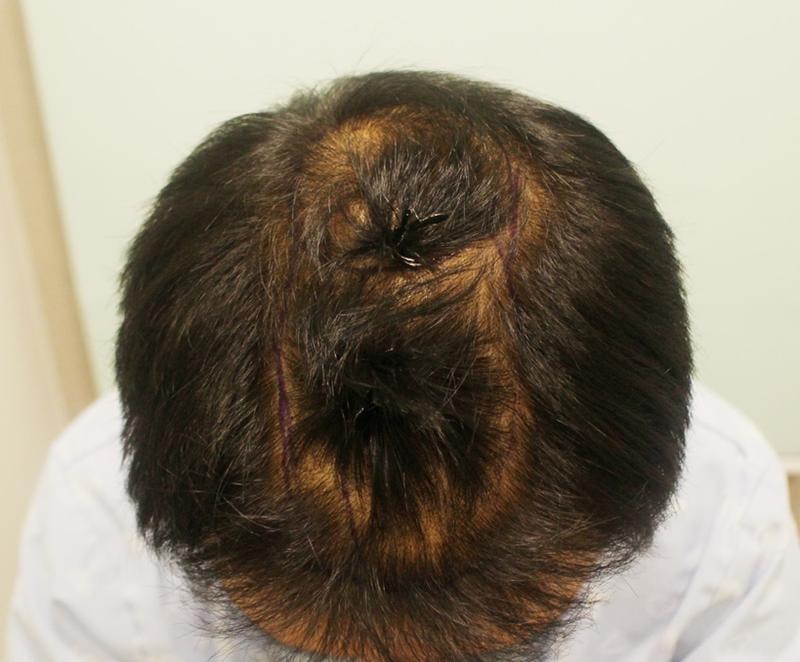 라인 정수리 밀도보강 1년~ (김주용원장님)