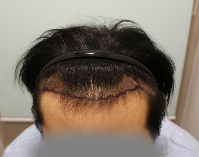 M자+헤어라인 이식 중간 단계 지납니닷