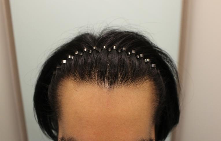 ヘアラインが細かくなることを願って植えてきました