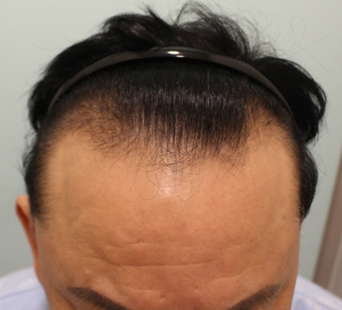 毛髪移植後、二番目のチェック