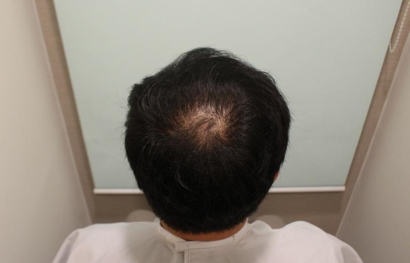 頭頂部/ヘアラインの手術後の変化
