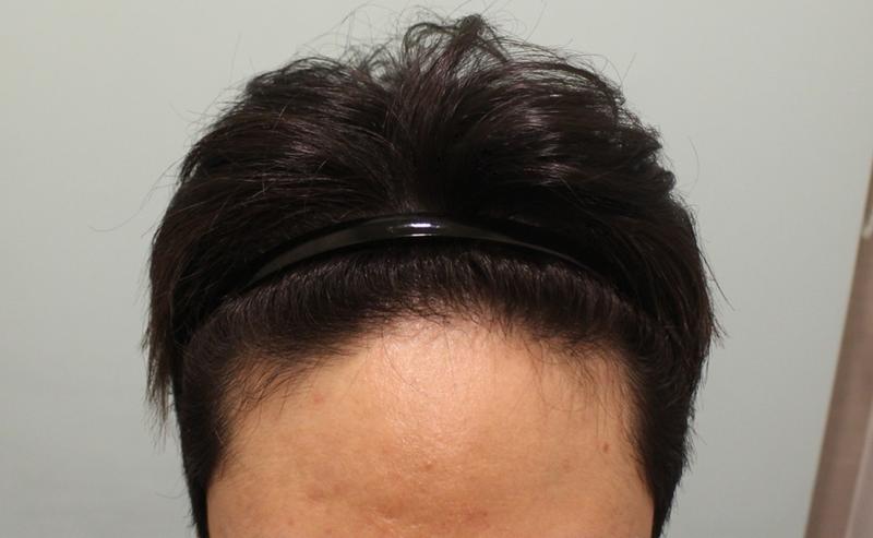 nチャヘアラインのほのぼのした移植後機です。