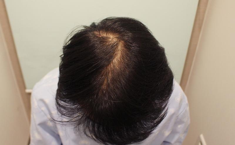 Dr. Charm's review of top hair transplantation