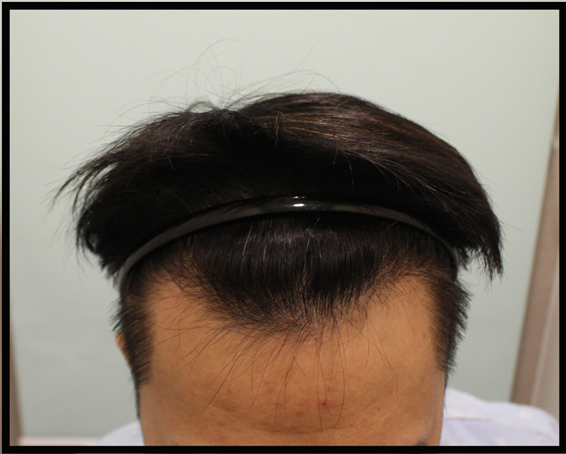 ヘアライン 非切開 2000毛 3ヶ月 満足度 Good