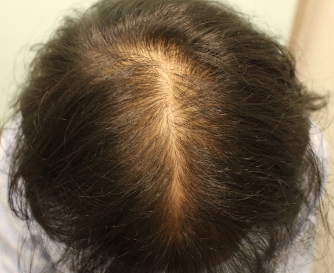 Dr. Charm's first procedure on top of the head