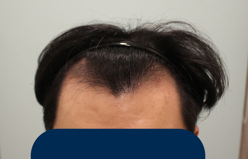 V자앞머리, 정수리 채운지 10개월