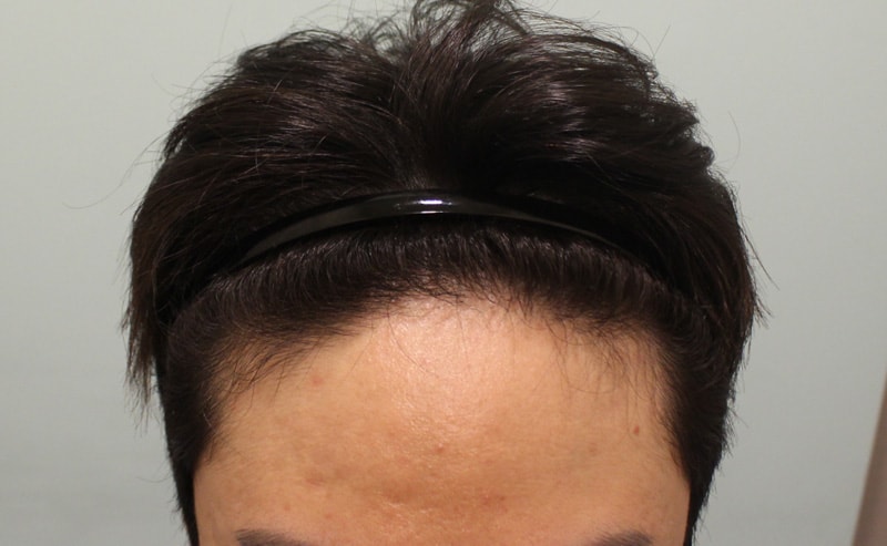 수술6개월 이후 시점이에요~