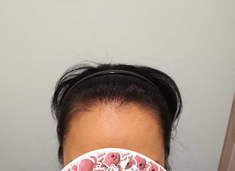 “넓은 이마 때문에 헤어라인교정 선택”