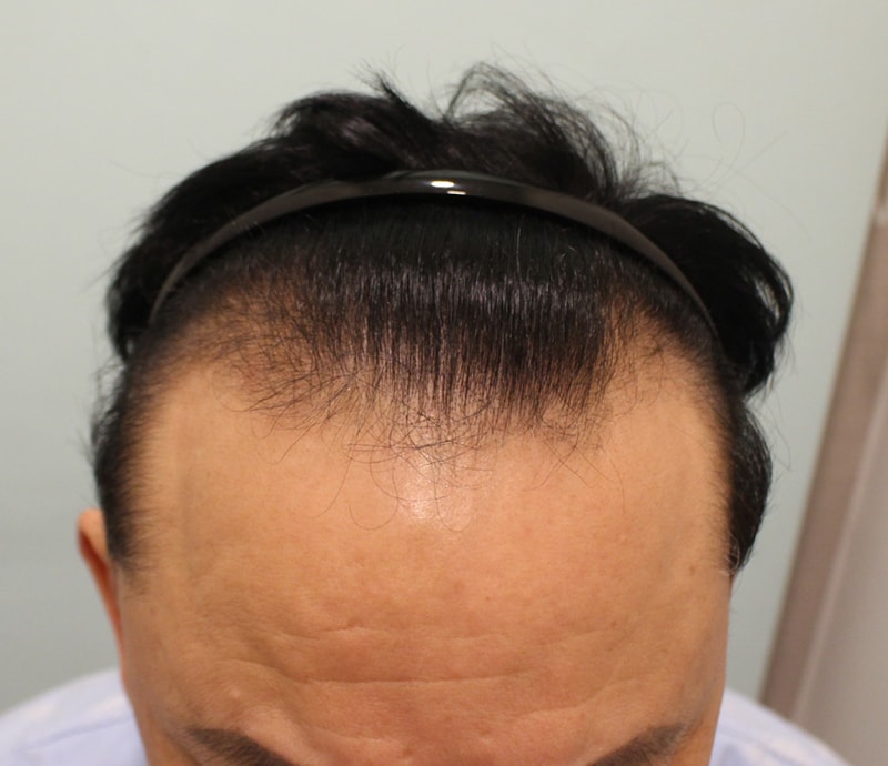 毛髪移植後、三番目のチェック