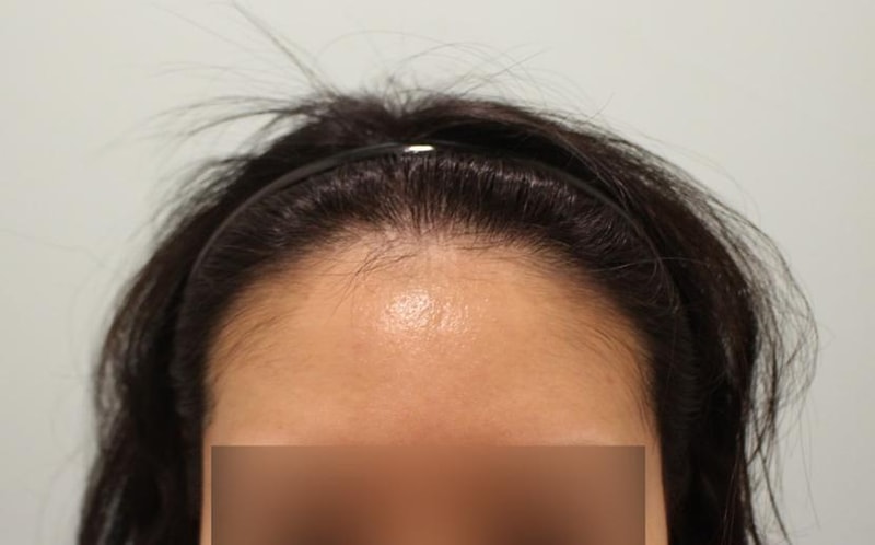 きれいになったヘアライン^^ 細かくなった分け目はボリュームも出てくる^^