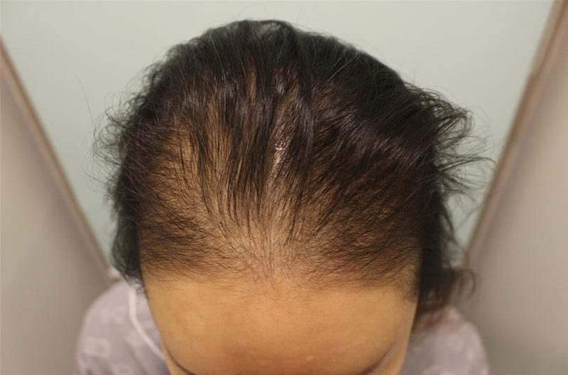 額の前面全体、ヘアラインの脱毛移植