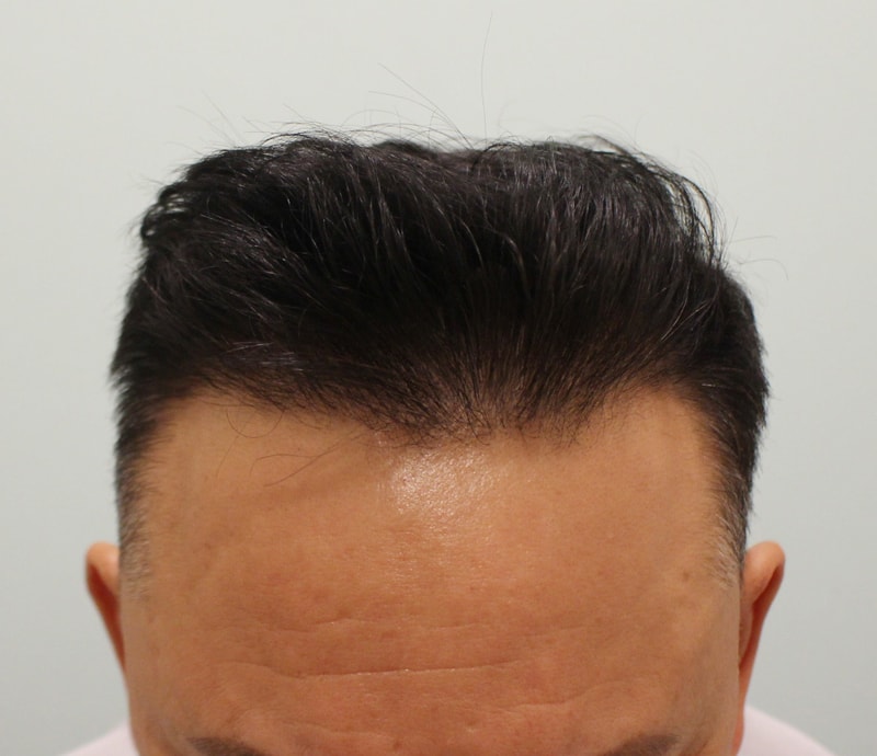 수술후 11개월_3.jpg