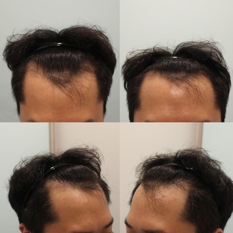 非切開ヘアラインM字毛髪移植後半経過<チャームドクターキム·ジュヨン院長>