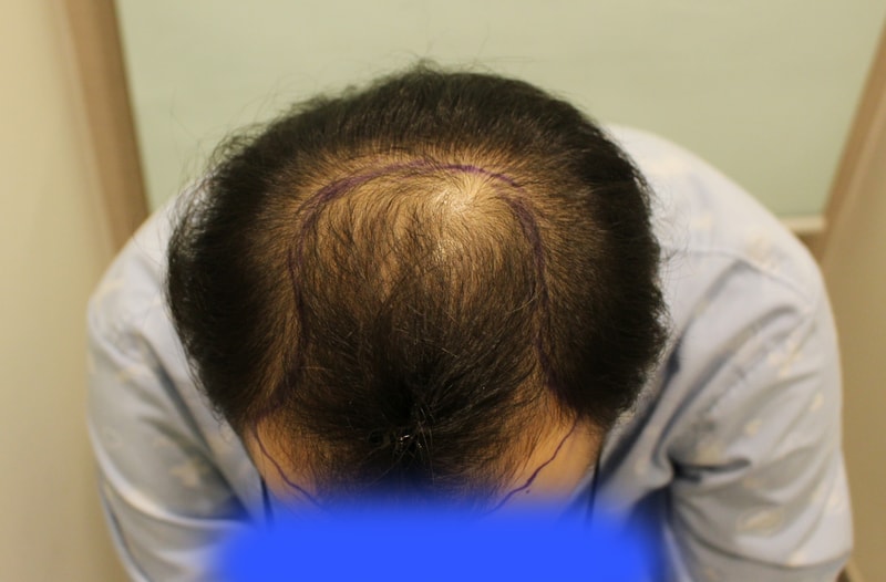 정수리 전체이식  후기요~