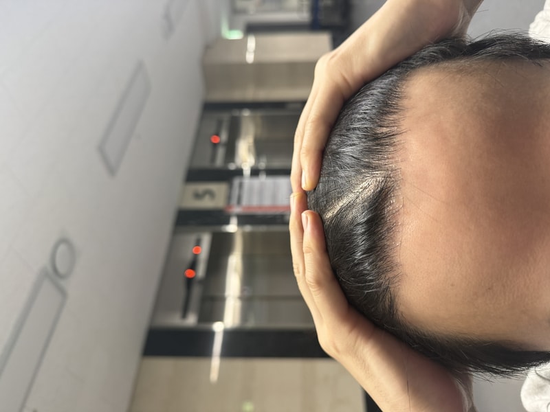 모재성 M자 2400모낭 약 1년차 후기입니다.