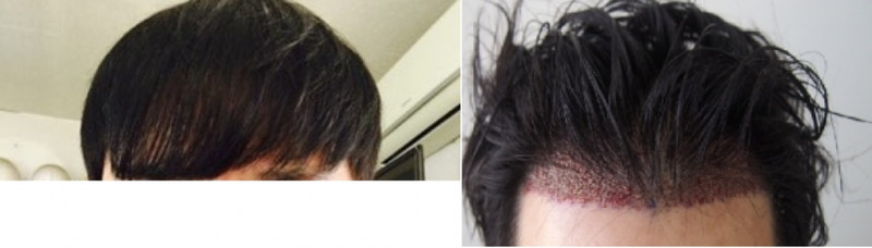 이식전.png
