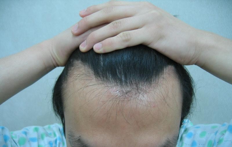 이식전올리고.jpg