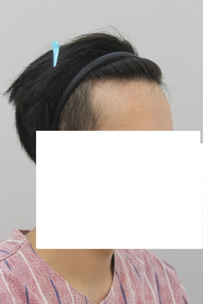 이식한 지 5개월좀넘었어요