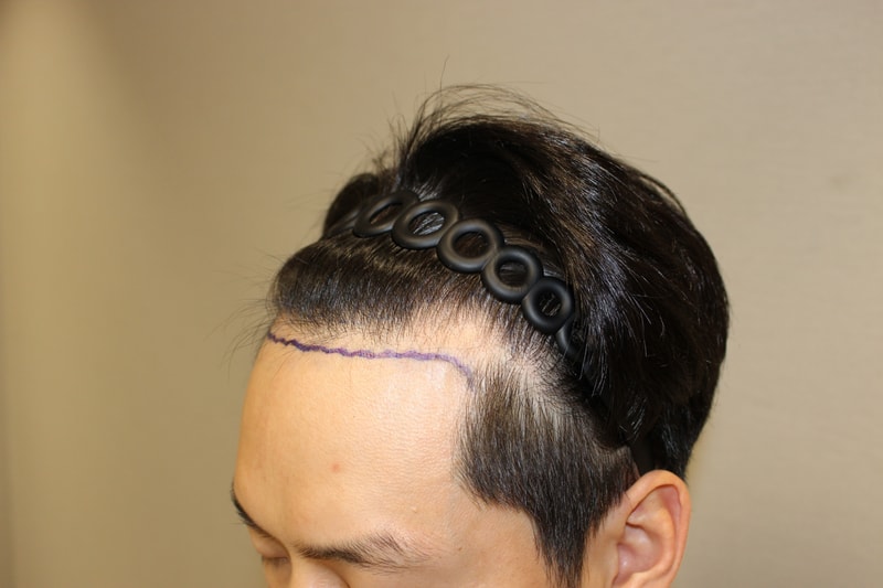수술전 왼.jpg