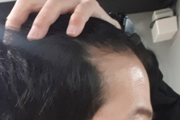 M-shaped non-cut 2000 mo 4 months. 3 months of comparison photo included
