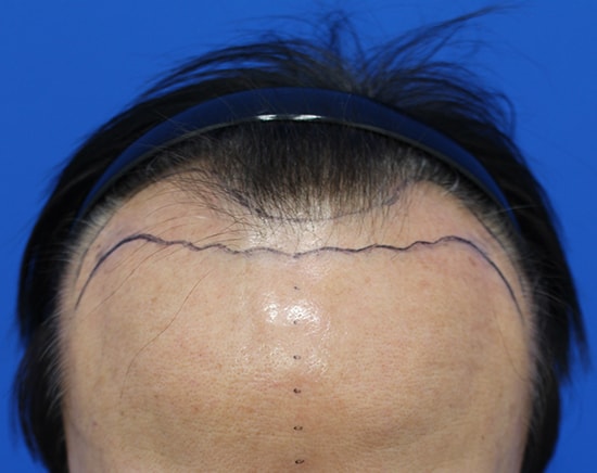 移植2224苗，头发重新长6个月。