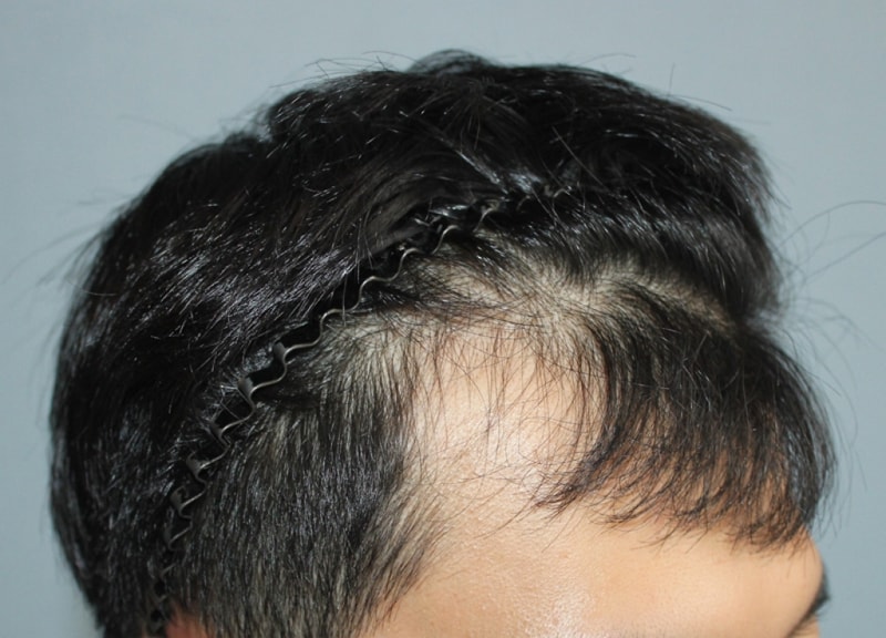 Charm Doctor, 2200 hair (1100 hair follicles), 2 years and 3 months, latest look!