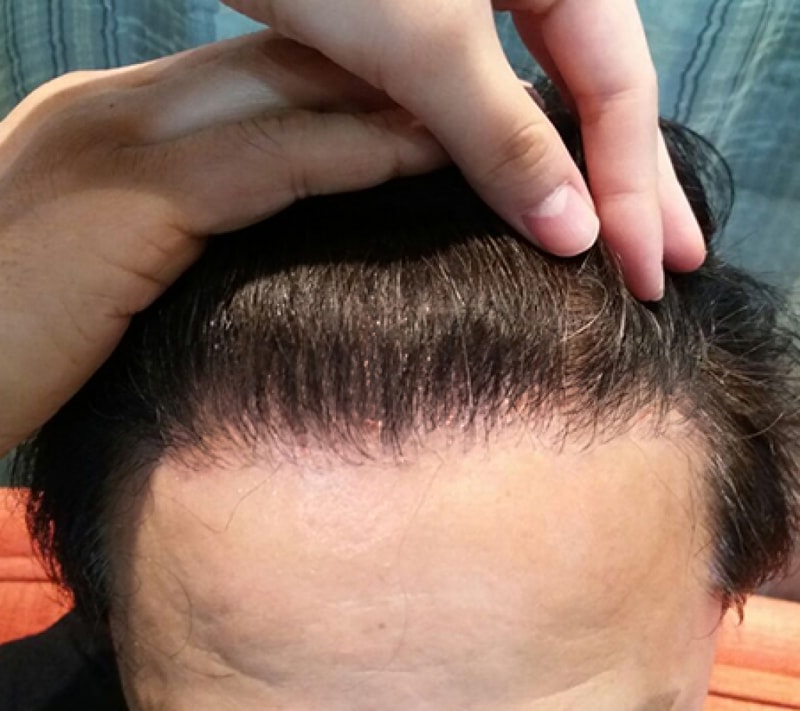이종민수술후8~9개월.jpg