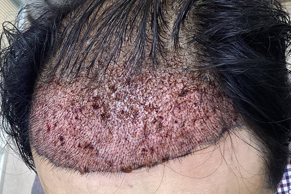 혼용 5천모 이식받고 6개월 지났습니다!