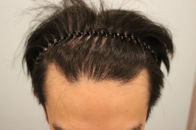 The results of the surgery came out. I'm leaving a review. (Hairline + Repair)