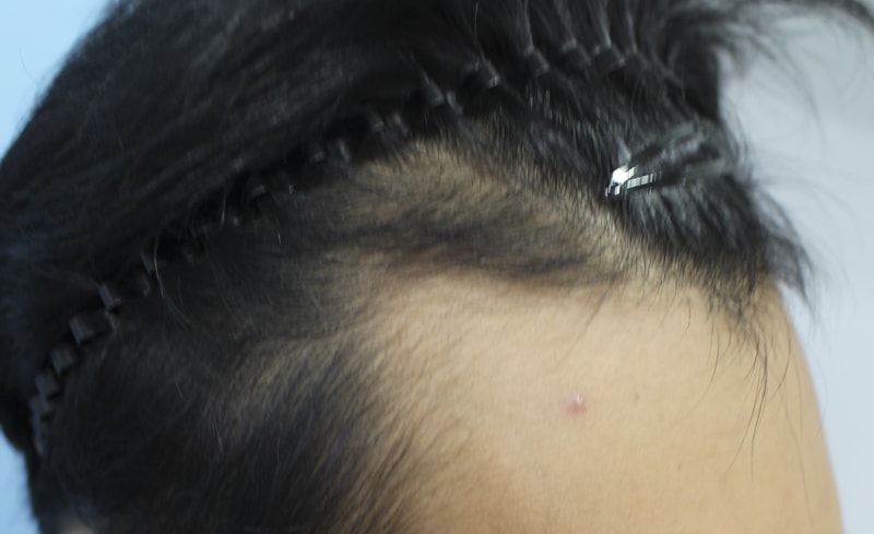 I had an M-shaped incision of 3,100 m