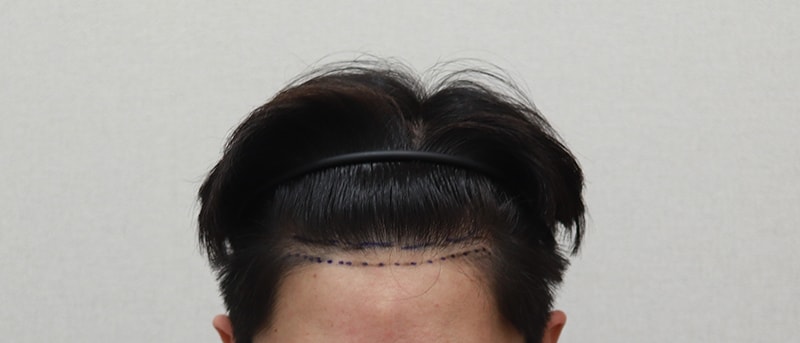 6 months review of MoPlus! (m-shaped + gouretnaru)