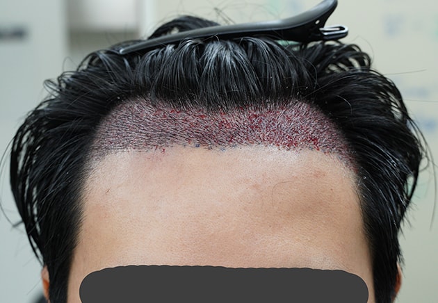 2600모 모모성형외과에서 받았습니당