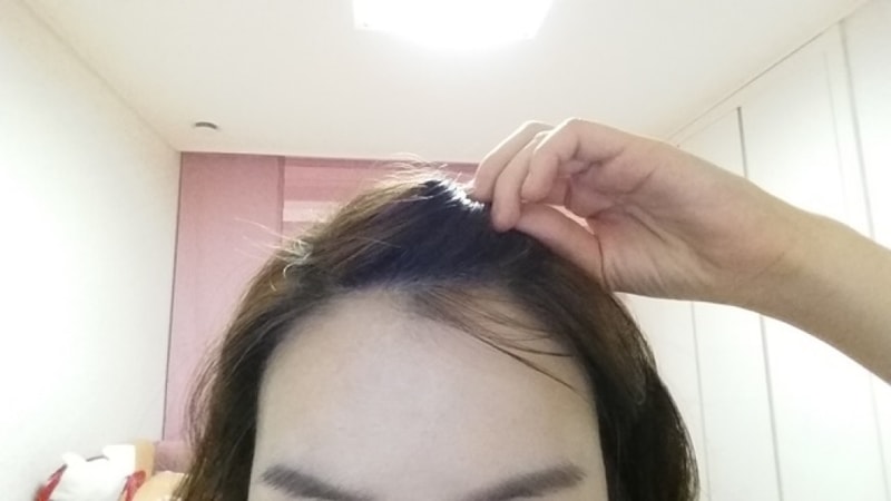ヘアライン10ヶ月目···10ヶ月になると余計なことを言うね···