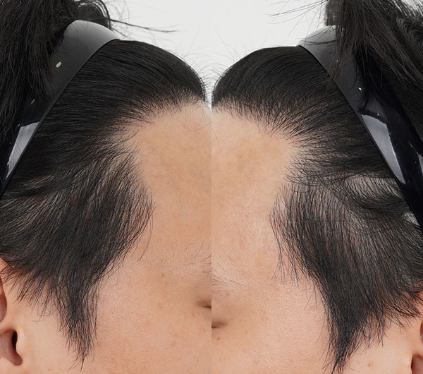 4 수술 후 옆면.jpg