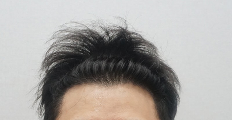 수술후_1.jpg