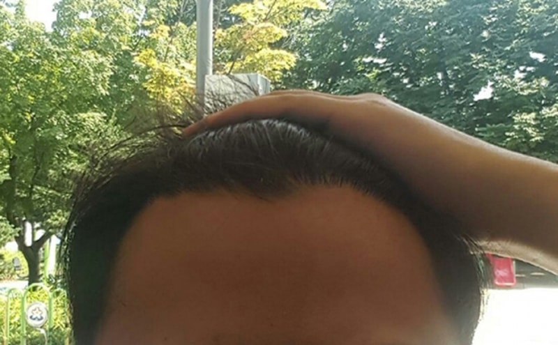 수술후셀카.jpg