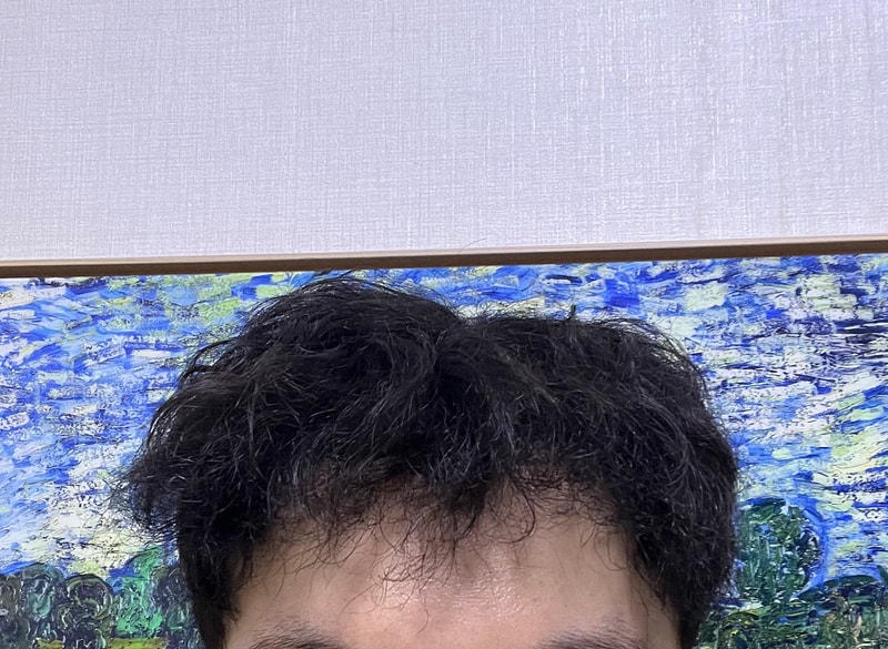 뉴헤어 서울점 비절개 모발이식 2000모낭 9개월후기입니다