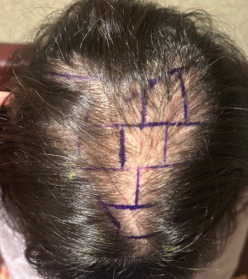 New Hair Day 7 Cut Hair Transplantation Review / 1700 Hair follicles