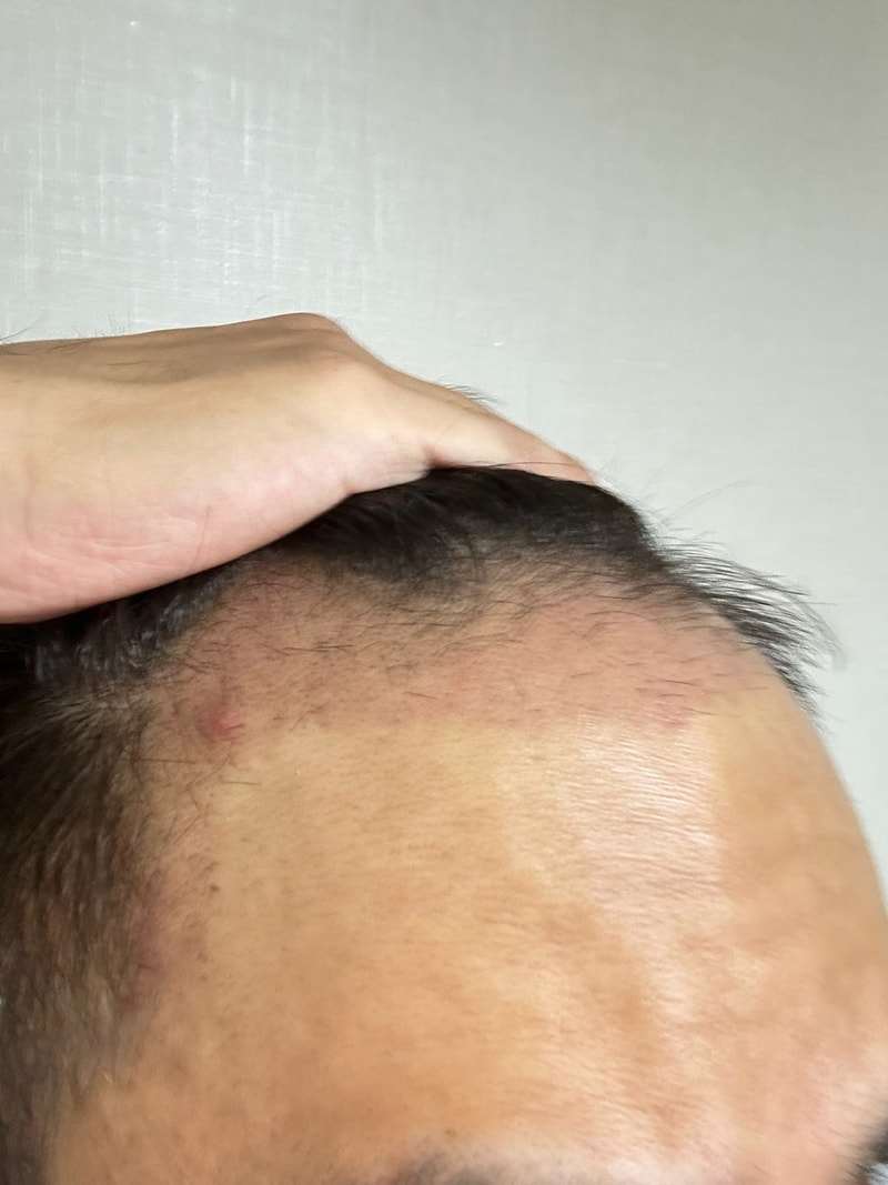 그로우의원(구 뉴헤어부산) 장태호원장님 m자 4500모 1달 후기