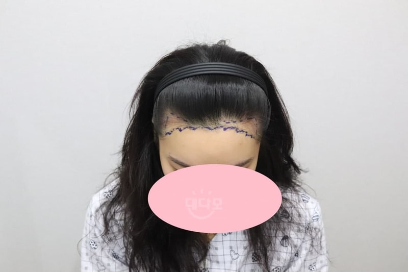 It's been 2 years and 2 months since I started MoPlus hairline!