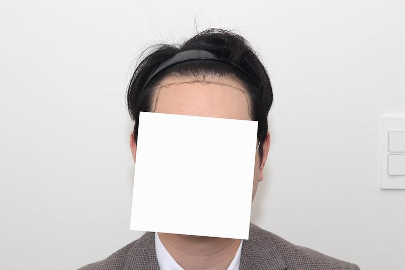 ニューヘア江南店 / 切開毛髪移植 / 1400毛包(2800毛)5日目のレビュー