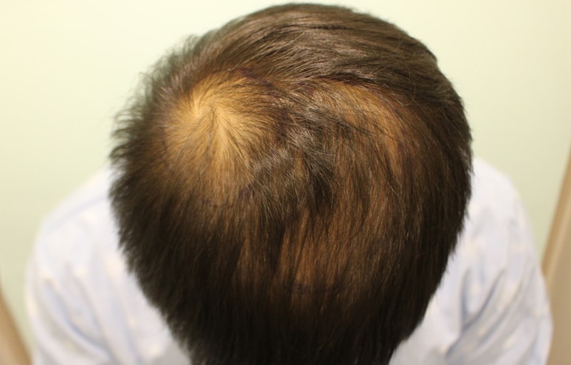8 months of parietal density transplantation. Highly recommended... Dr. Charm
