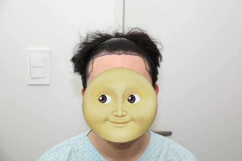 뉴헤어 절개 모발이식 1800모낭(3600모) 수술 1년 후기
