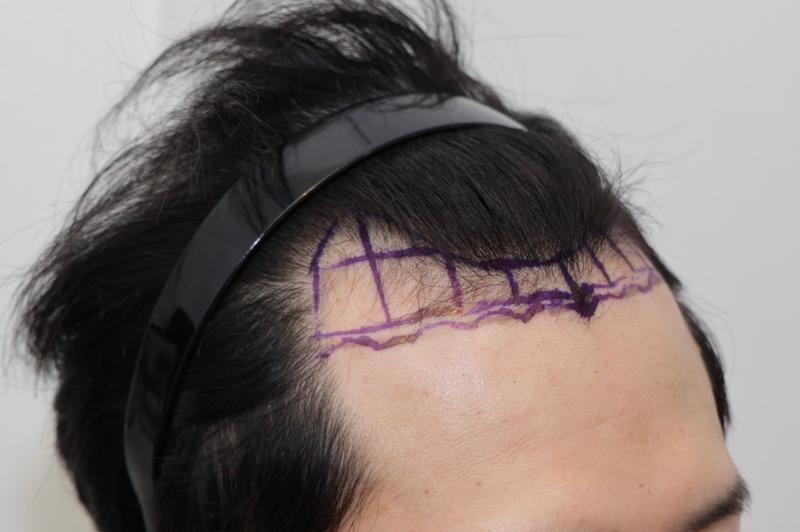 ニューヘア ヘアライン矯正 1700毛包 3ヶ月レビュー
