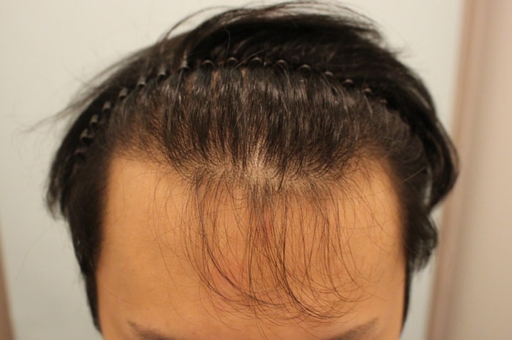 Hairline Bee, 2500-mo surgery for up to one year