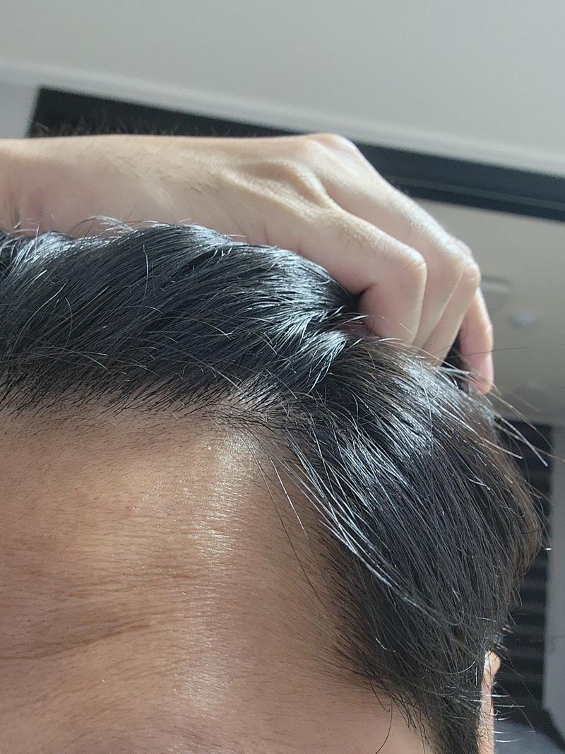 New Hair 首尔店无剃头非切开 1486 毛囊 12个月后期（高勇旭院长）