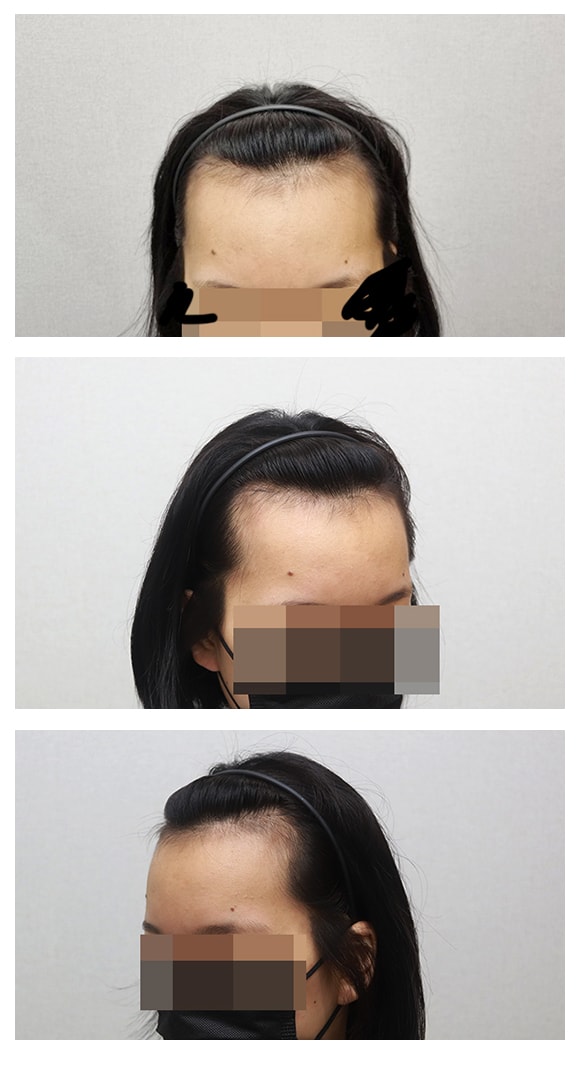 모플러스 성형외과 헤어라인 수술 후기!