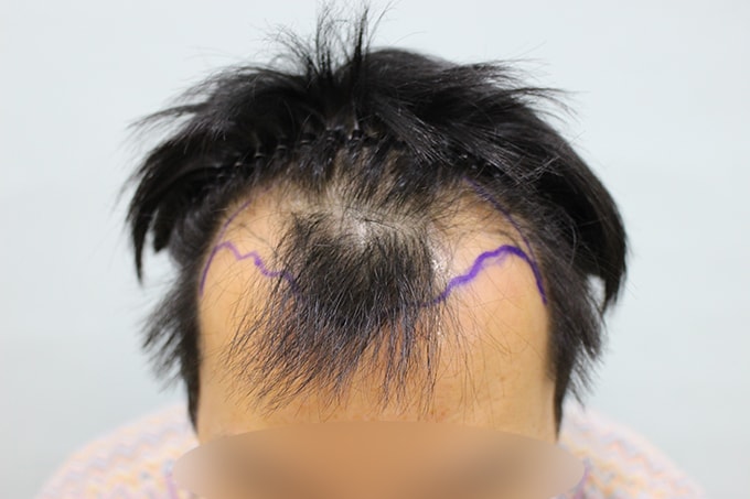 수술전.jpg