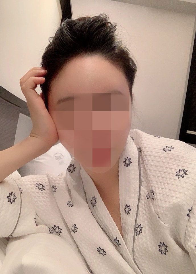 ヘアライン非切開一ヶ月目のレビューです~！