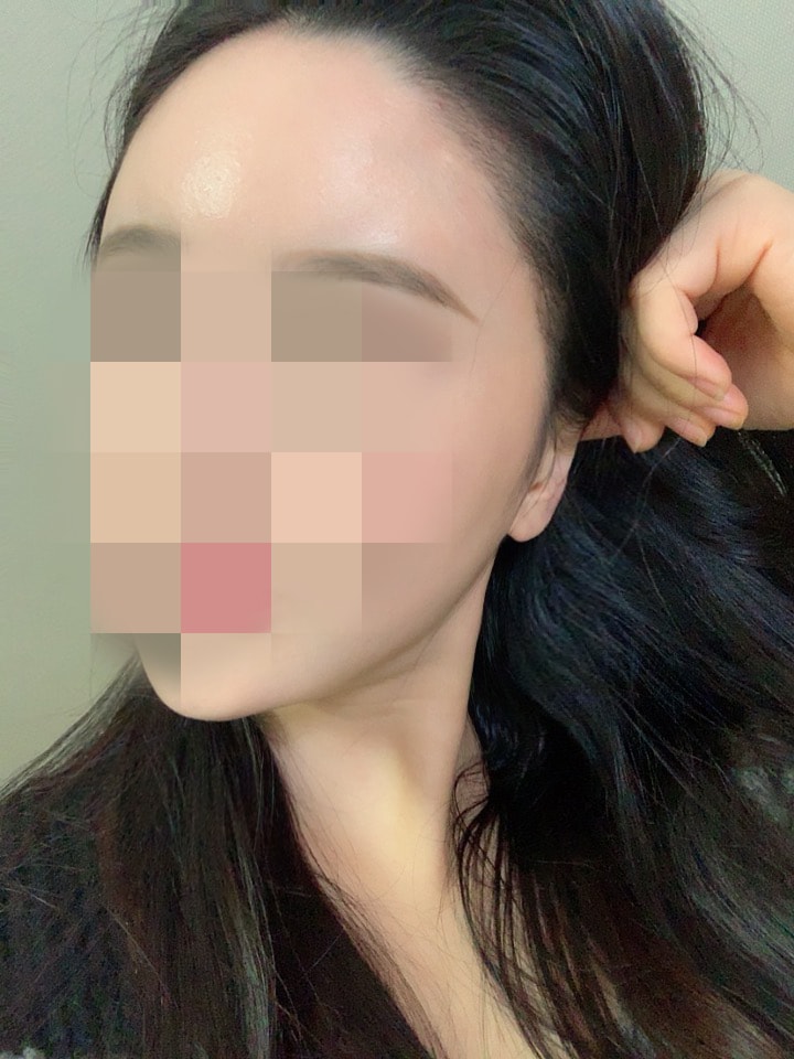 수술두달02.jpg